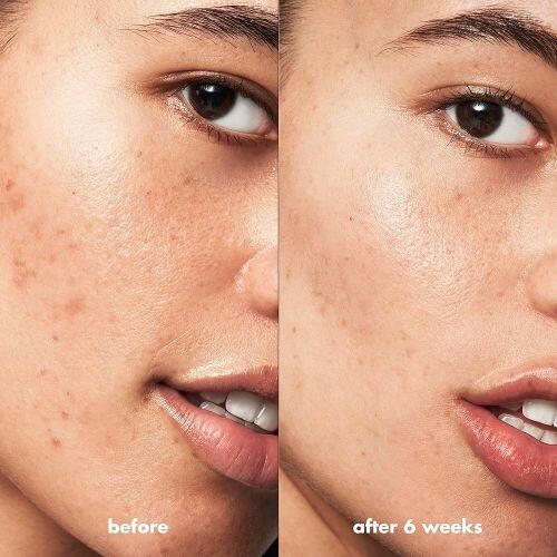 ELF SKIN - BLEMISH BREAKTHROUGH ACNE FIGHTING SPOT GEL